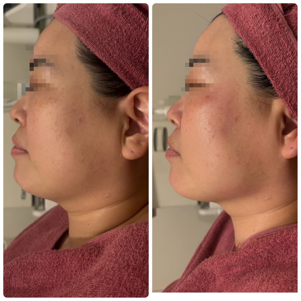 Non-Surgical Lift Up Treatment